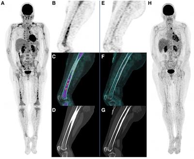 First use of 18F-FDG PET in TEMPI syndrome: can it be used for treatment assessment? A case report